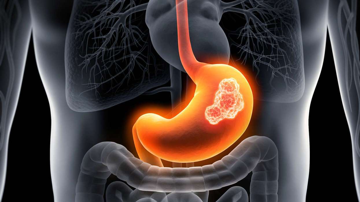 New immunotherapy offers hope to patients with aggressive stomach cancer