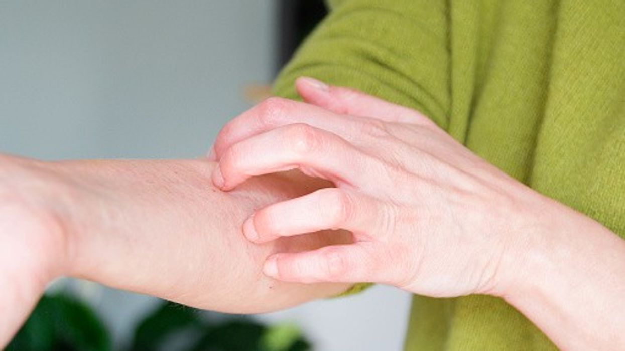 Adults with moderate to severe chronic hand eczema