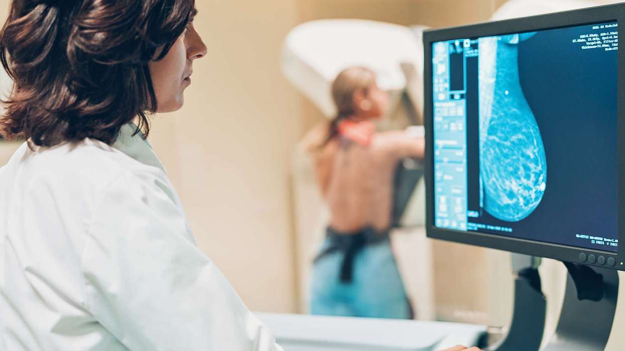 AI Beats Doctors at Detecting Breast Cancer: Study
