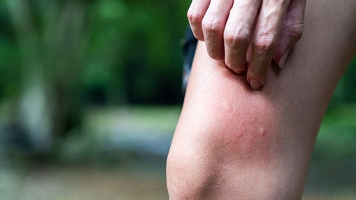 Heatwave Sparks NHS Advice Searches for Insect Bites