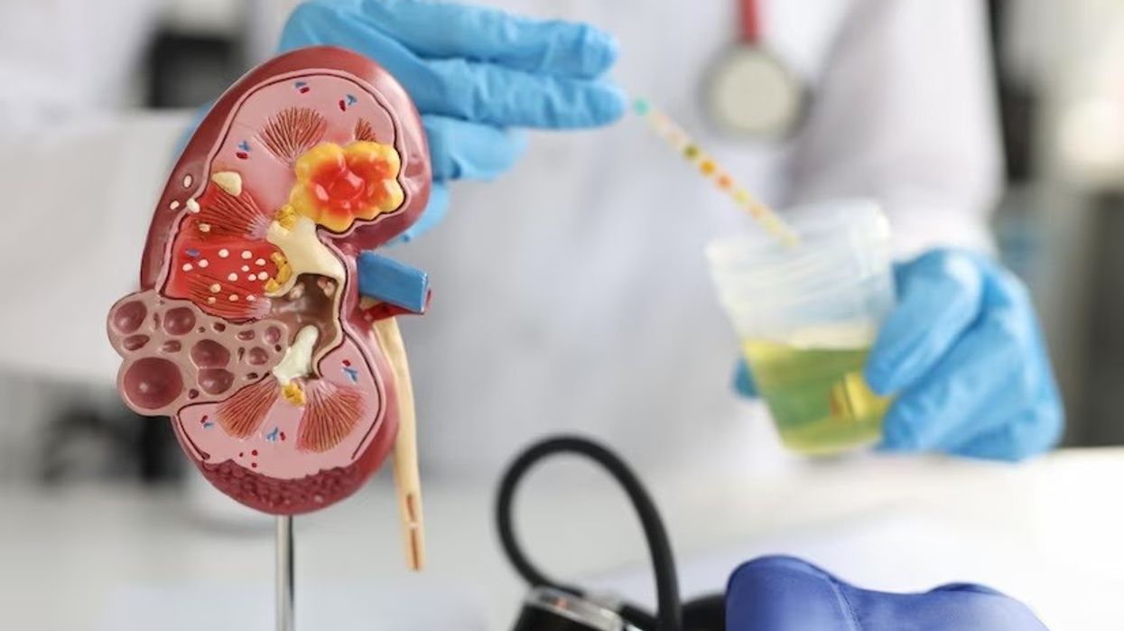 NHS England begins at-home testing for chronic kidney disease