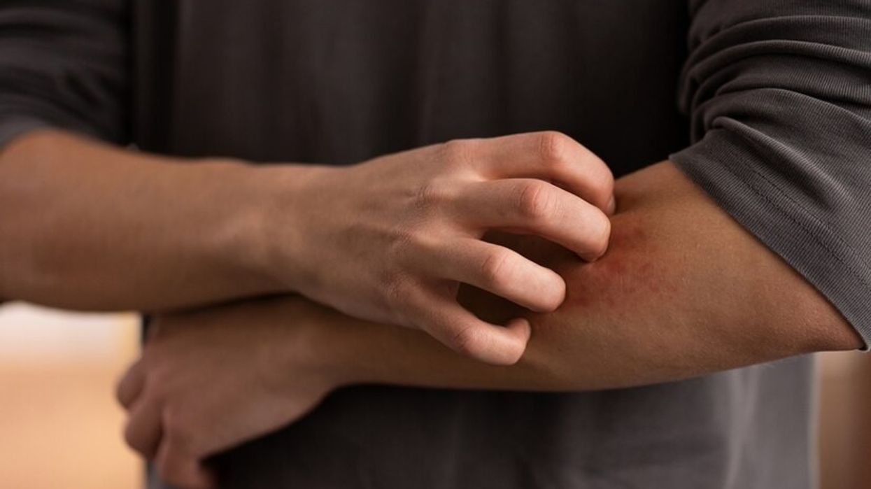 Scabies outbreak in UK: Drug shortages contributing to rise in cases, confirm dermatologists