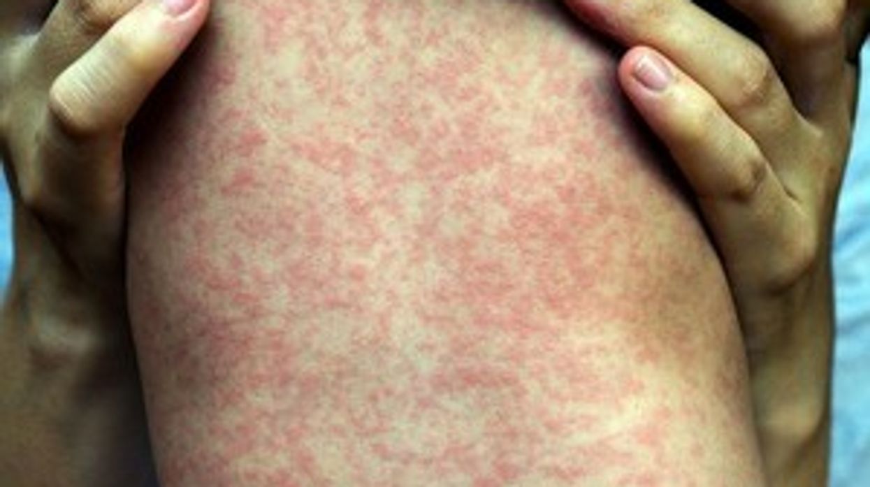 Measles outbreak in England: 127 more cases confirmed