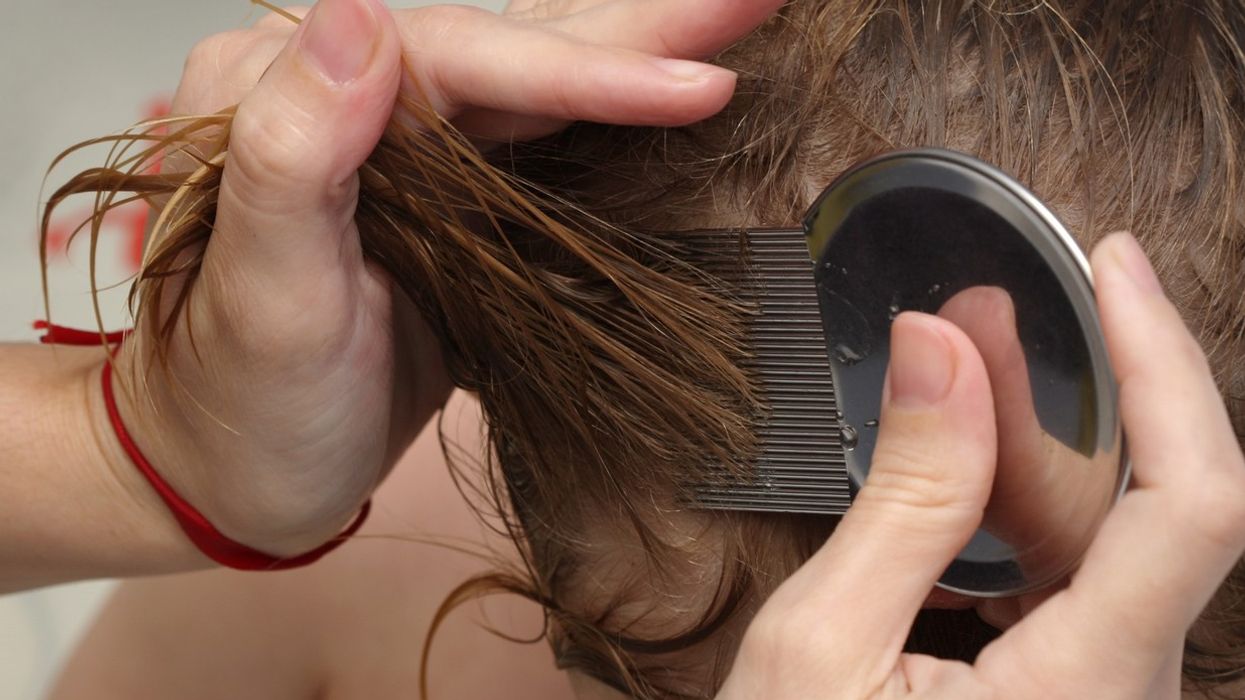 Head lice cases on the rise across the UK, warns Superdrug