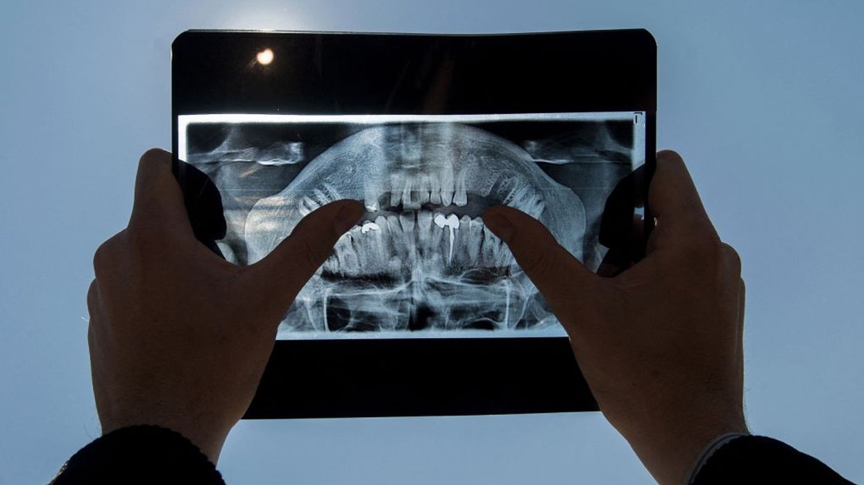 New KCL study reveals link between gum disease and stroke in young patients