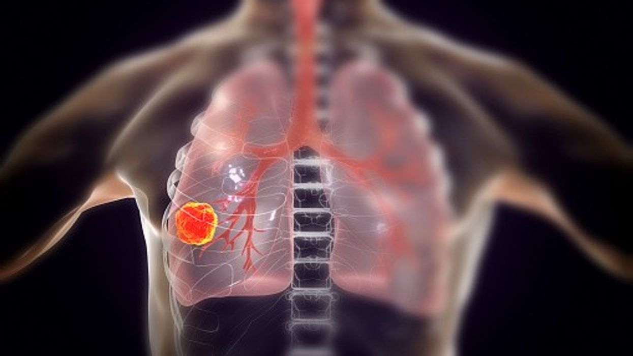 Advanced lung cancer: HSE approves reimbursement for Merck’s TEPMETKO® in Ireland