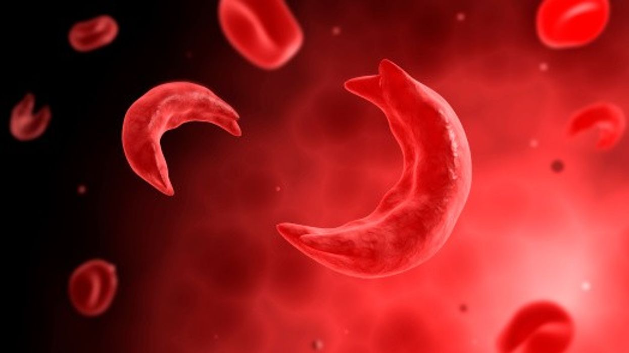 Sickle cell disease is poorly understood amongst pharmacists - PDA report reveals