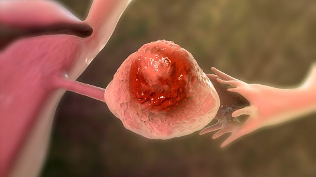 World’s first ovarian cancer vaccine: University of Oxford awarded £600,000 for OvarianVax
