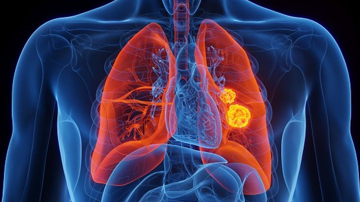 UK approves CStone’s Sugemalimab for non-small cell lung cancer treatment