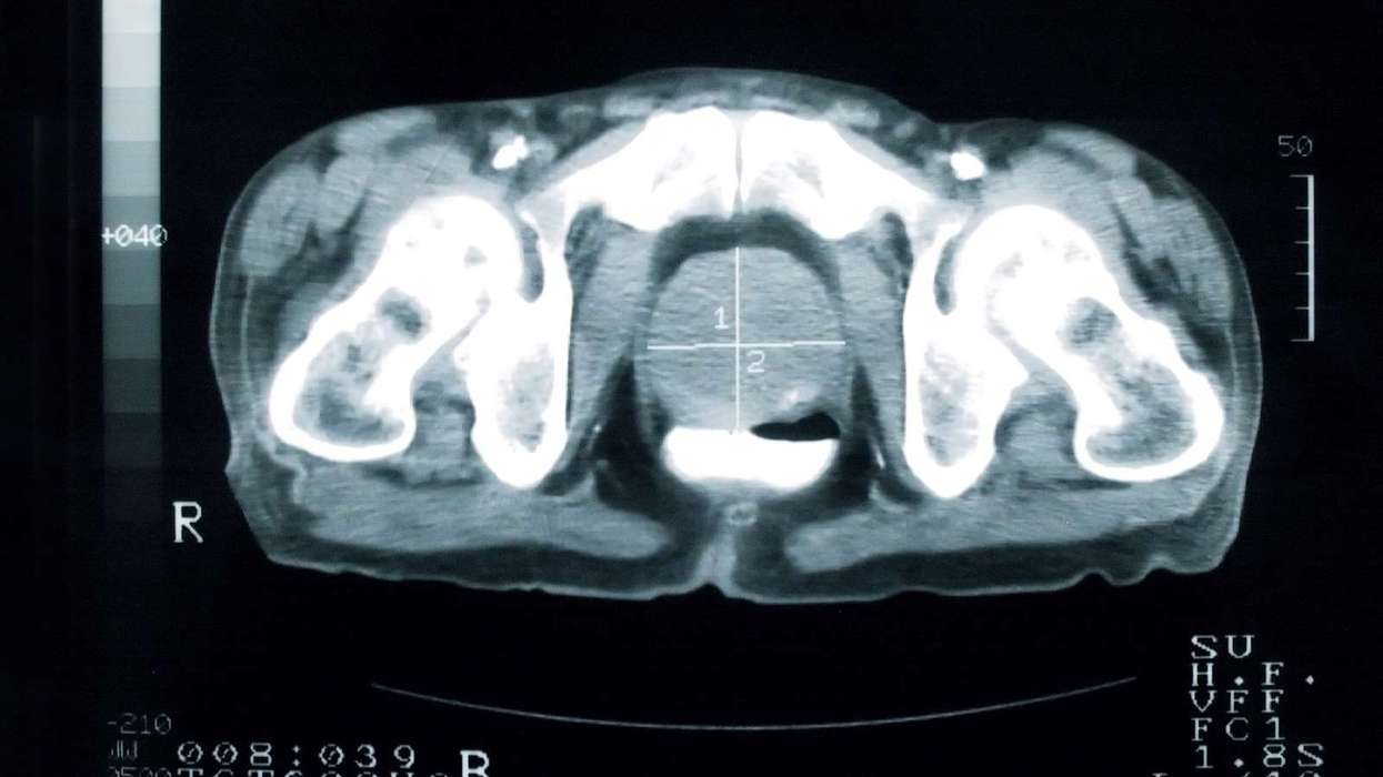 Limit prostate cancer screening to high-risk groups: NSC
