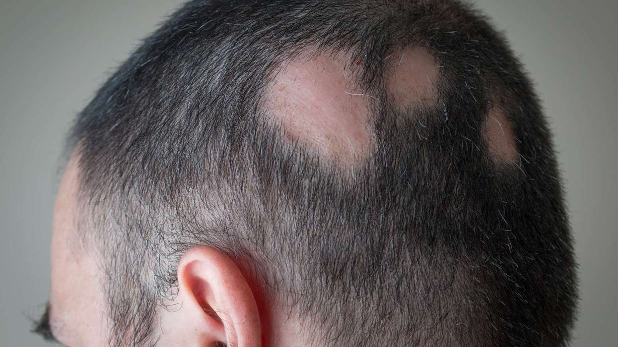 MHRA Approves Deuruxolitinib for Alopecia Areata