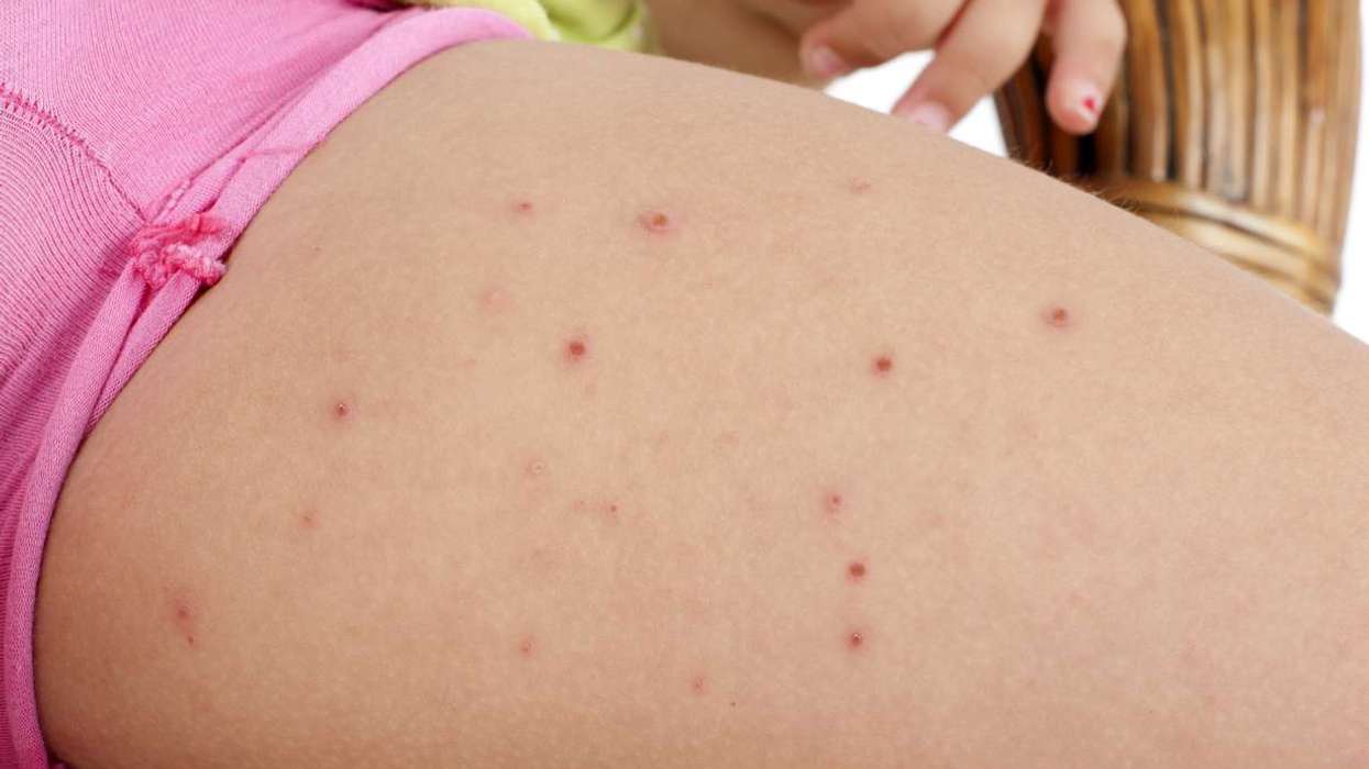 MHRA approves Donidalorsen to treat hereditary angioedema