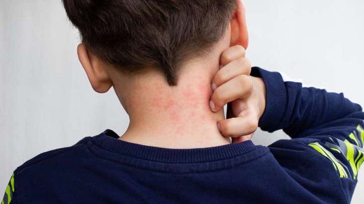 MHRA approves needle-free allergy nasal spray for younger children