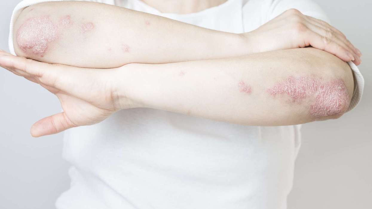 MHRA approves new drug to treat plaque psoriasis