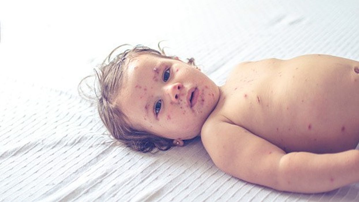 MMR vaccine for Children