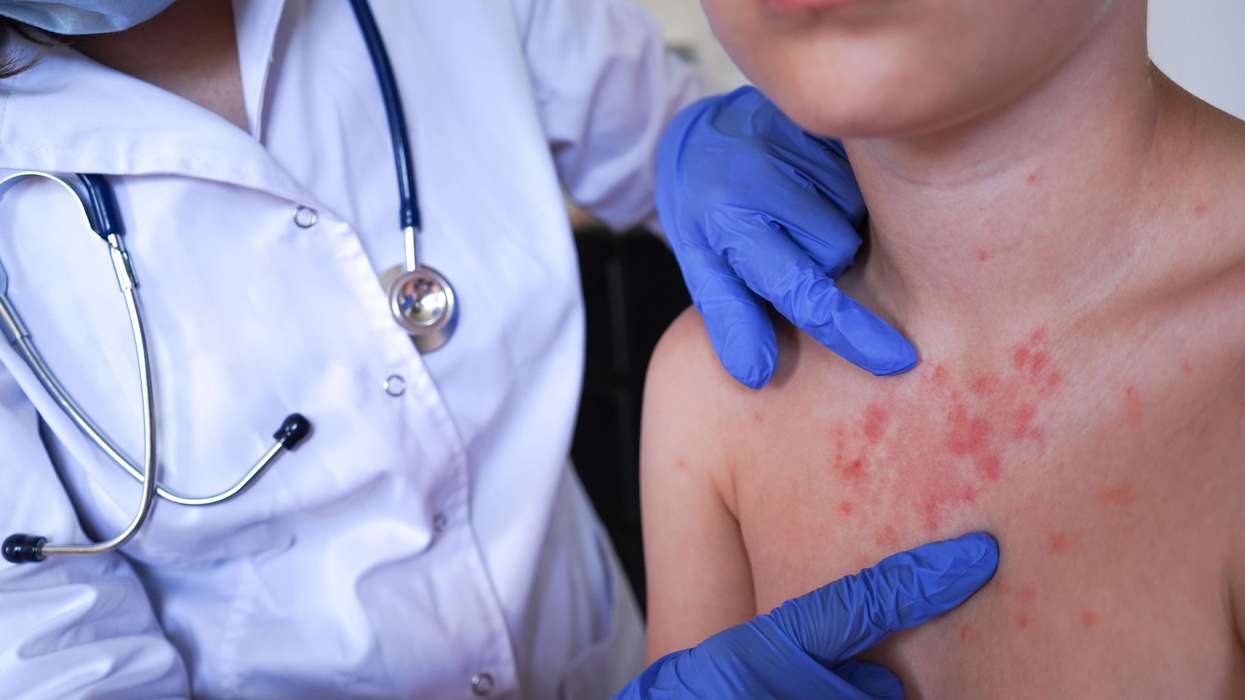 Rare 'crusted scabies' outbreak forces closure of hospital ward in Wales