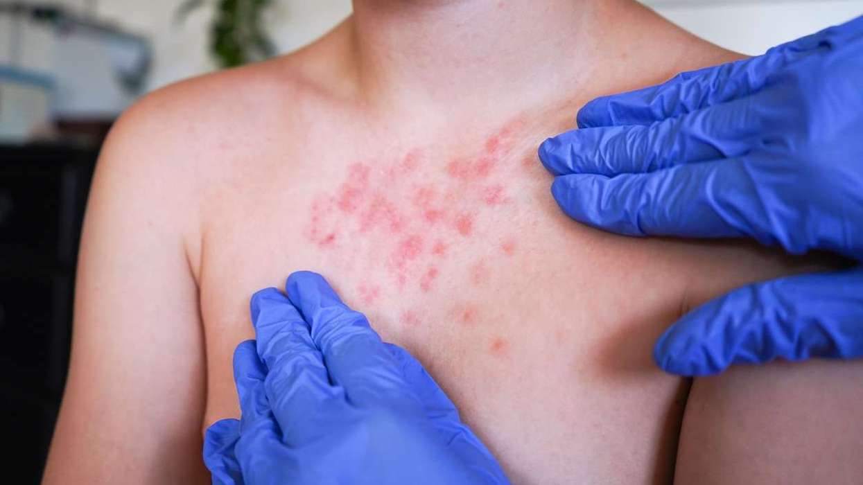 Scabies cases rise in Wales