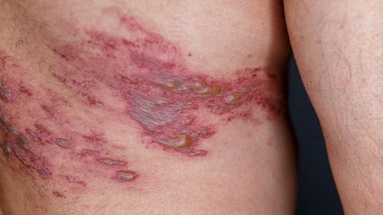 NHS expands shingles vaccine eligibility to more immunosuppressed adults