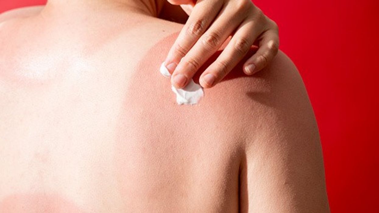 The sensitive skin of children and infants are prone to get sun-related skin cancers via repeated exposure