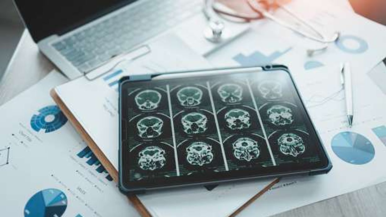 A simple blood test can help detect Alzheimer’s: Study