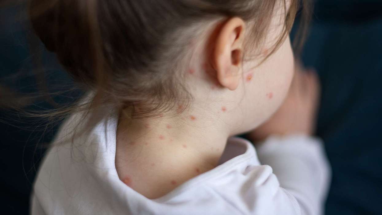 This year’s measles cases surpass 2025, half of them in London