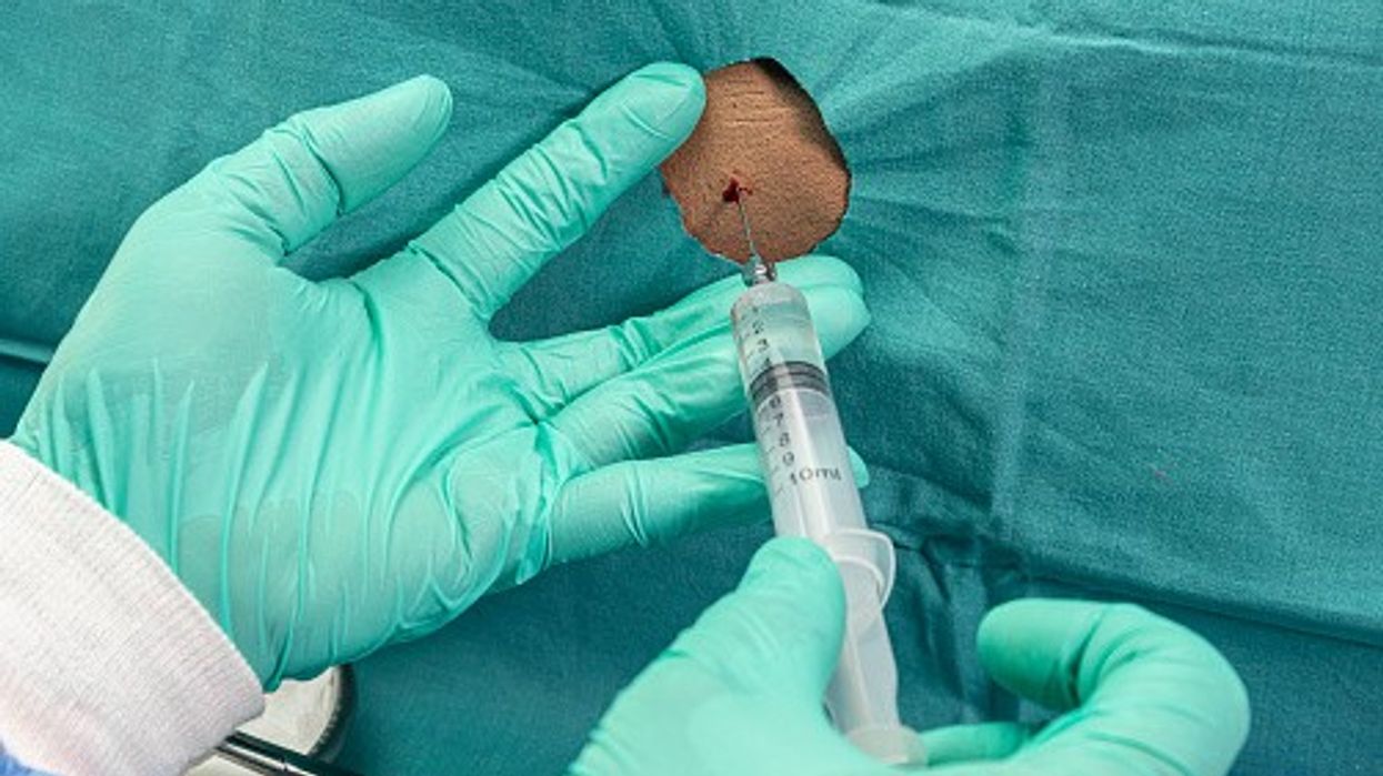 Tofersen is administered via the procedure of lumbar puncture or injection into the lower spine