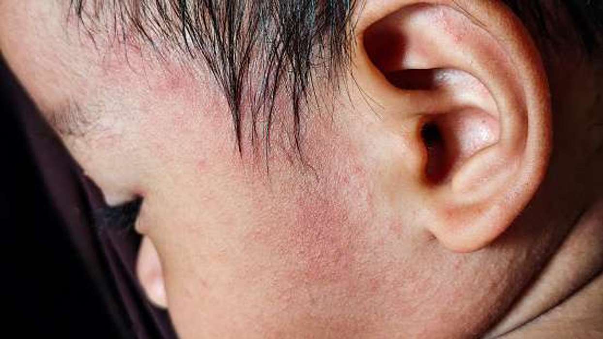 UK measles elimination status lost