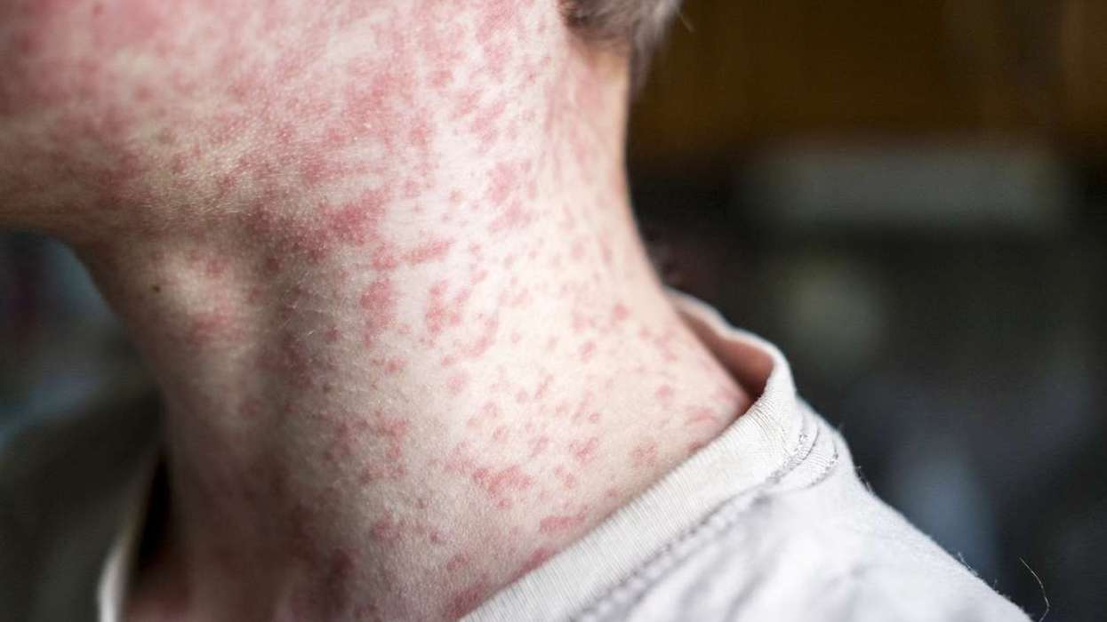 UKHSA warns of rise in measles cases this year