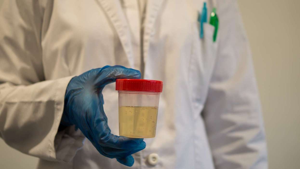 Urine test for bladder cancer shows promise during trials