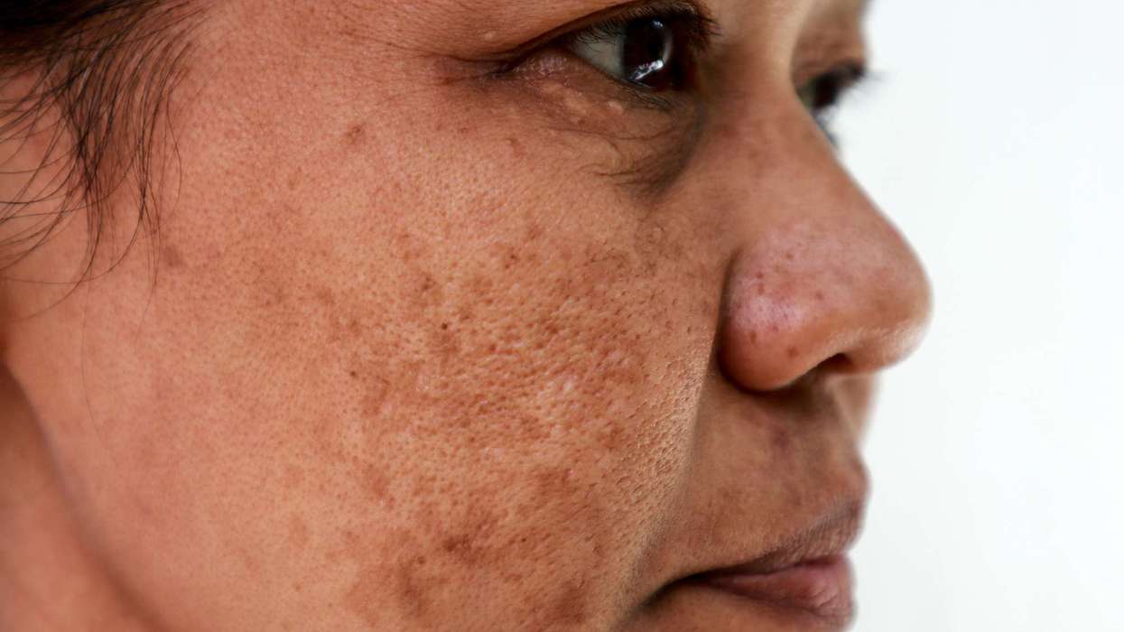 Winter skincare tips