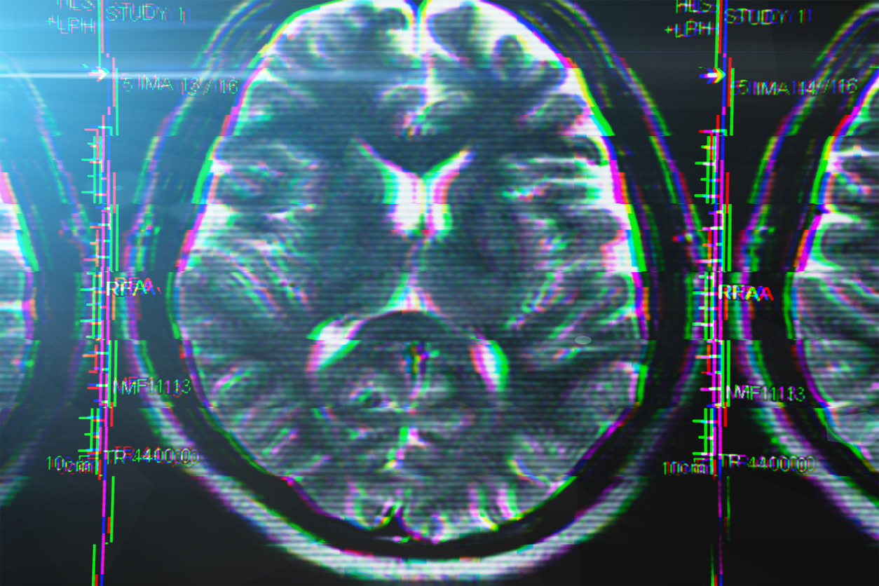 It seems like Alzheimer’s but peek into brain shows a mimic