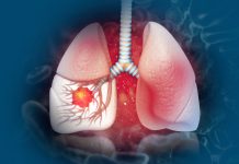 Tepotinib for advanced lung cancer