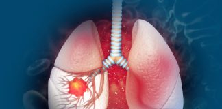 Tepotinib for advanced lung cancer