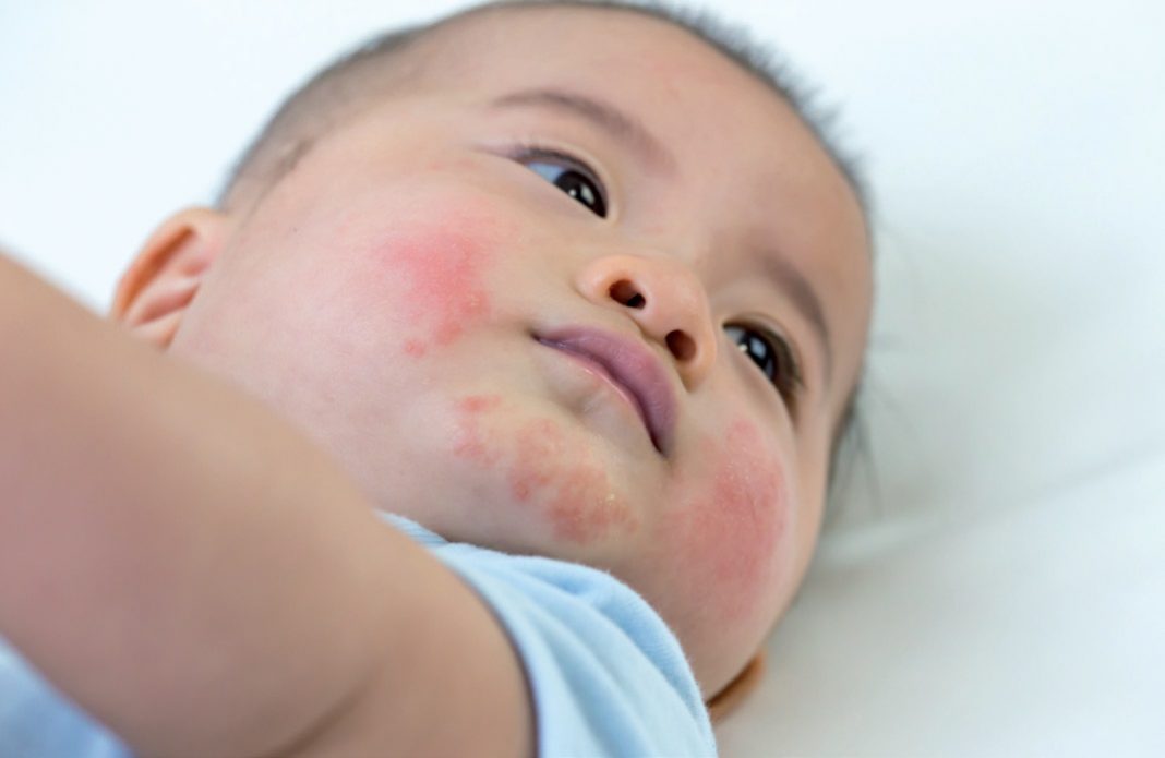 Eczema in children